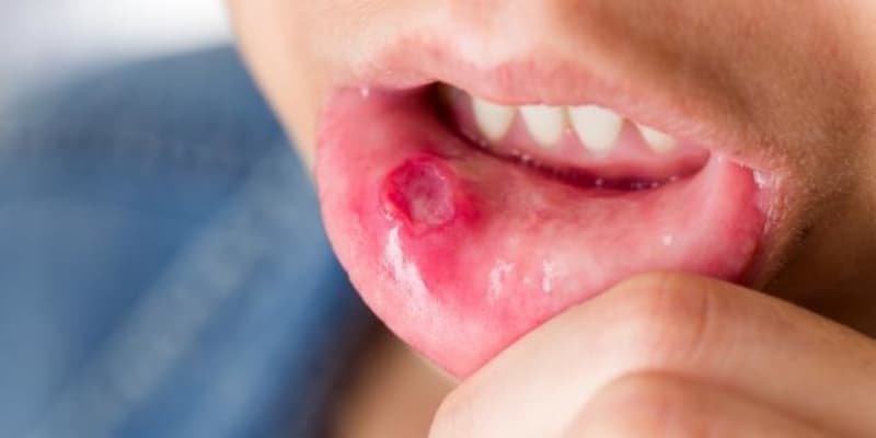قرحة الفم.. أسبابها وأعراضها وكيفية الوقاية منها