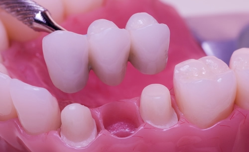 أهمية وطريقة تلبيس الأسنان