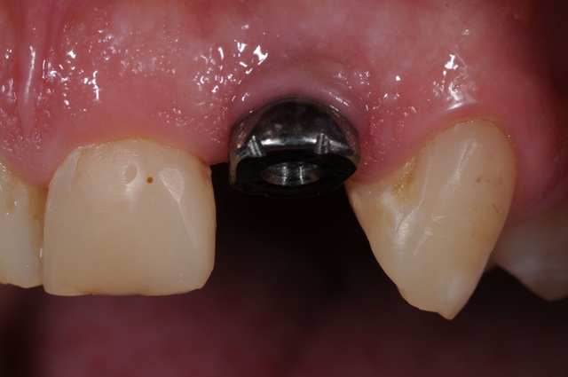عيوب زراعة الأسنان..أشياء قد تقلقك بعد إتمام عملية زراعة الاسنان