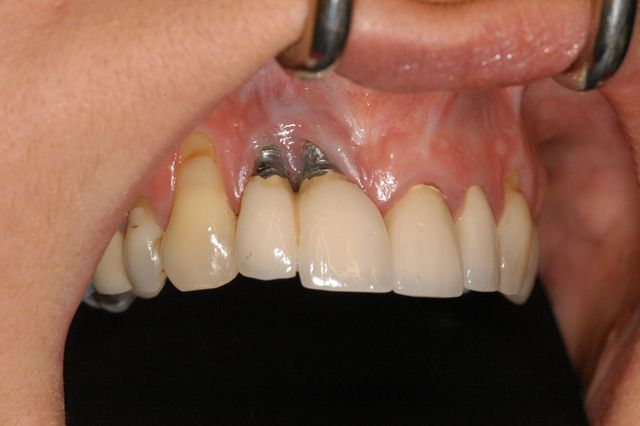 مشاكل زراعة الأسنان ومضاعفاتها الخطيرة التي قد تفقدك الأسنان المزروعة