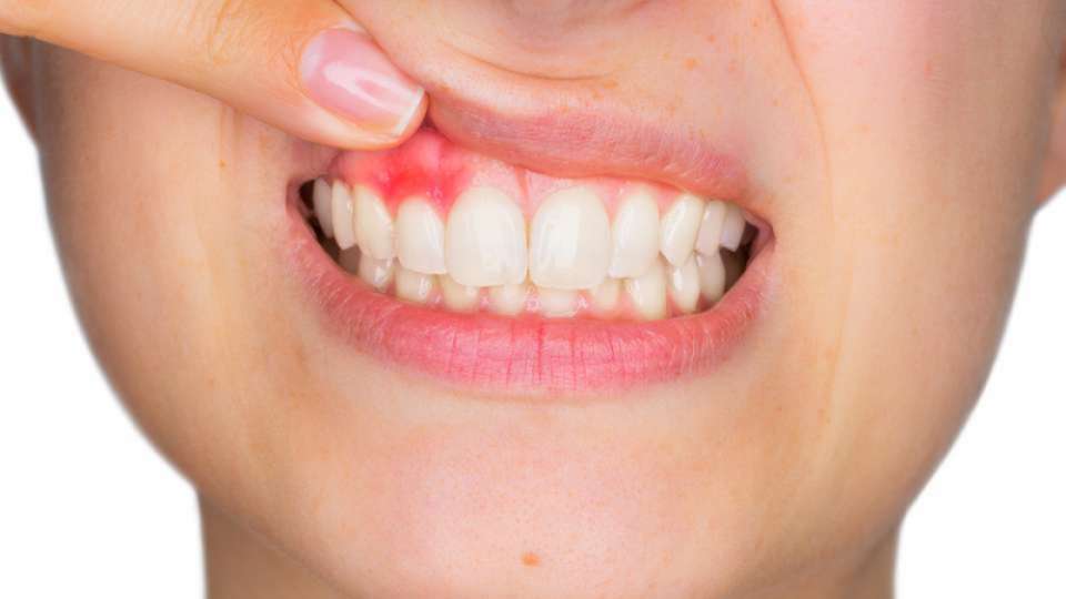خراج الأسنان: ما هي أسبابه؟ وكيفية علاجه؟