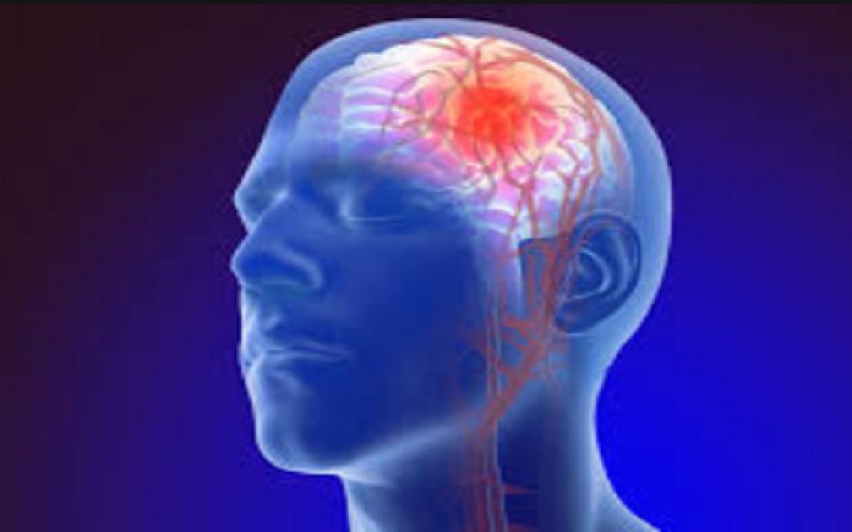 5علامات..تعرف على أبرز أعراض السكتة الدماغية