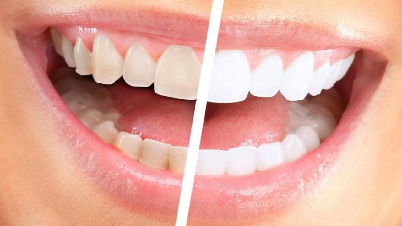 طريقة سحرية رخيصة لإزالة جير الأسنان والتخلص من رائحة الفم الكريهة طوال اليوم