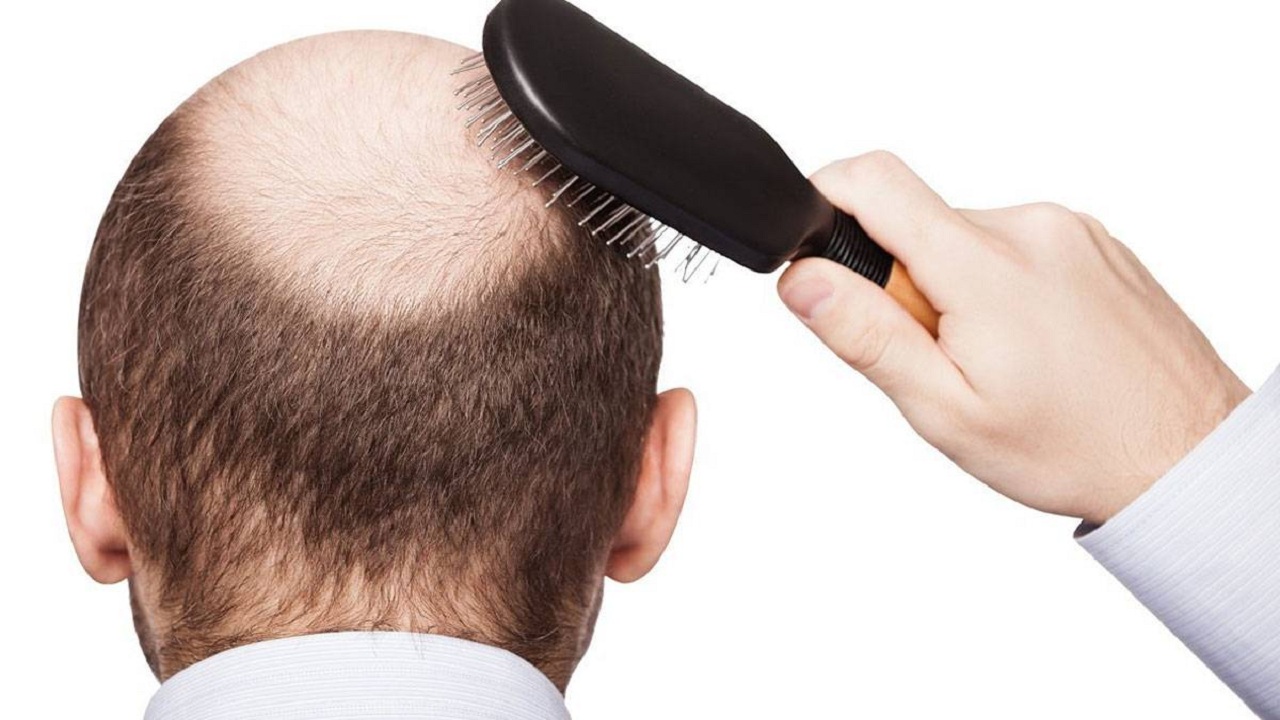 4 نصائح ذهبية لعلاج تساقط الشعر في الشتاء