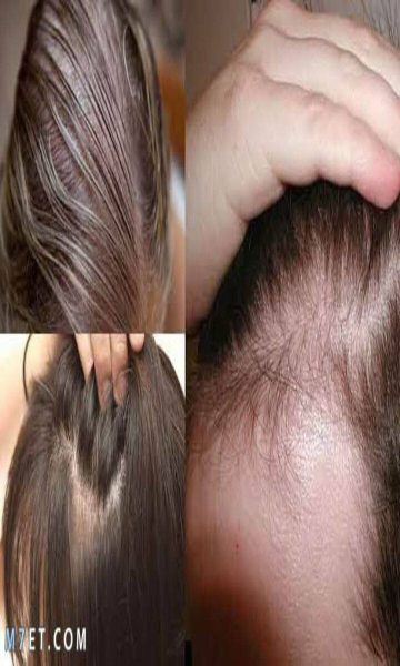 فوائد الروزماري والقرنفل في أنبات الشعر
